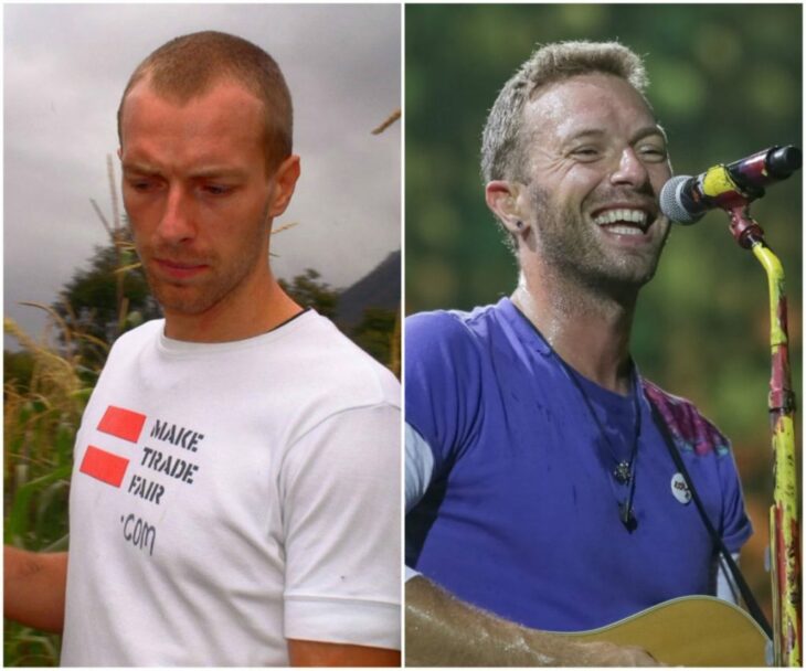 Chris Martin antes y después del injerto de cabello 