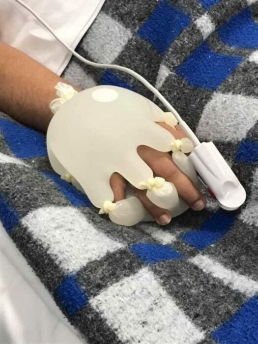 Guantes de látex rellenos con agua y sosteniendo la mano de un paciente 