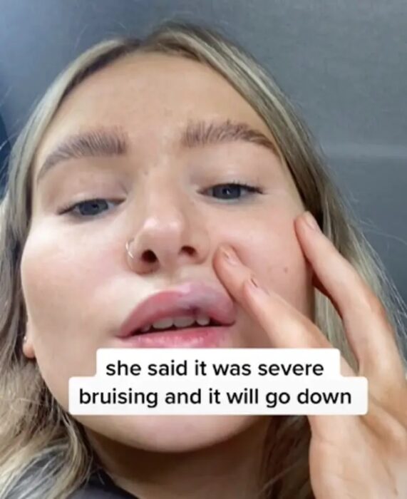 Chica mostrando los riesgos de rellenarse los labios 