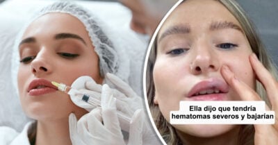 TikToker advierte lo serio que puede ser rellenarse los labios sin la ayuda de un profesional