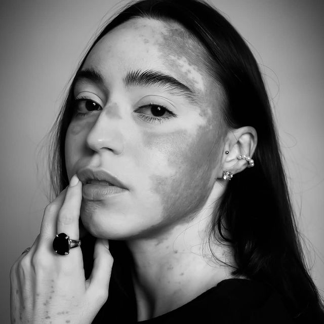 Mujer con vitíligo supera sus problemas de confianza luego de