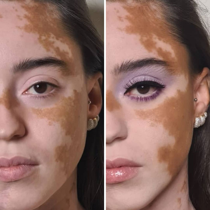 Mujer con vitíligo supera sus problemas de confianza luego de
