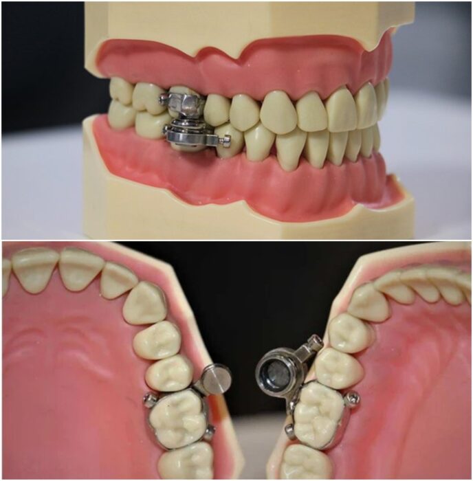 dentadura con candado de imanes ;Crean candado para mantener la boca cerrada y cumplir la dieta; internet ya reaccionó  