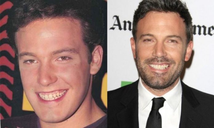 Ben Affleck; 13 Famosos que le deben su hermosa sonrisa al dentista