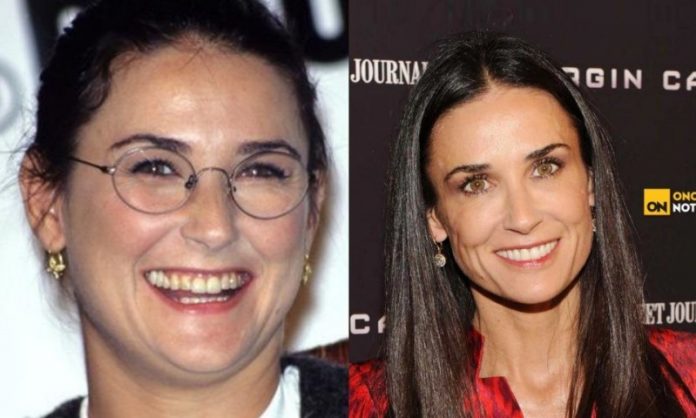 Demi moore; 13 Famosos que le deben su hermosa sonrisa al dentista