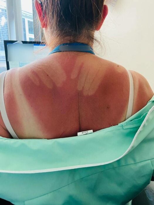 Mujer fue a la playa y terminó con marcas por la crema solar 