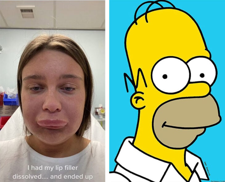 imagen comparativa de una chica con cara hinchada y Homero Simpson