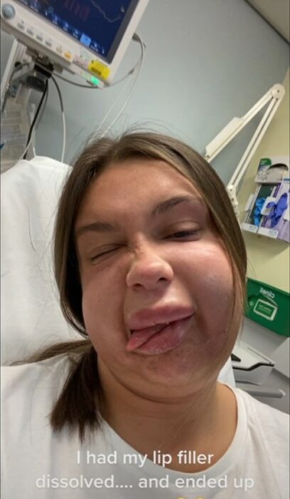 girl with swollen face sticking out her tongue