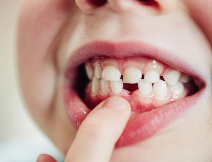 boca de un niño mostrando que se le cayó un diente 