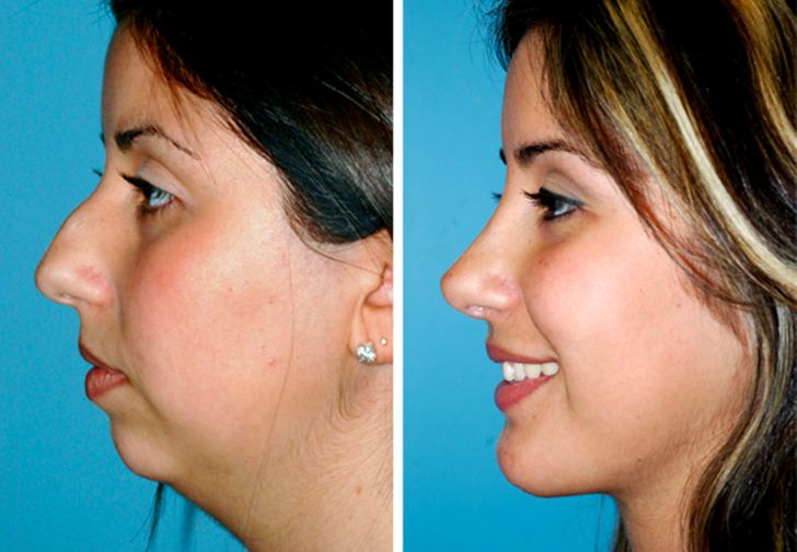 Person with cosmetic surgery that improved their face