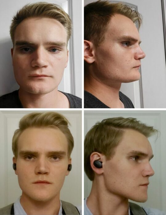 Persona con un cirugía estética que mejoró su rostro
