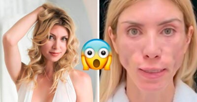 Reina de belleza ya no puede sonreír ni cerrar los ojos por una mala cirugía