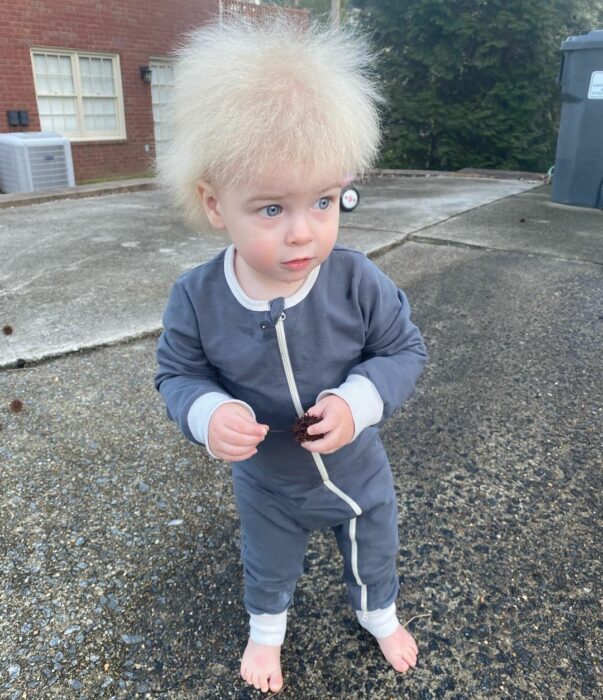 Locklan el niño con el síndrome del cabello imposible de peinar 