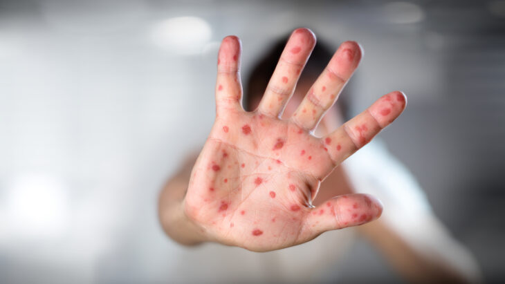 Belgium is the first country to impose mandatory quarantine for those infected with monkeypox