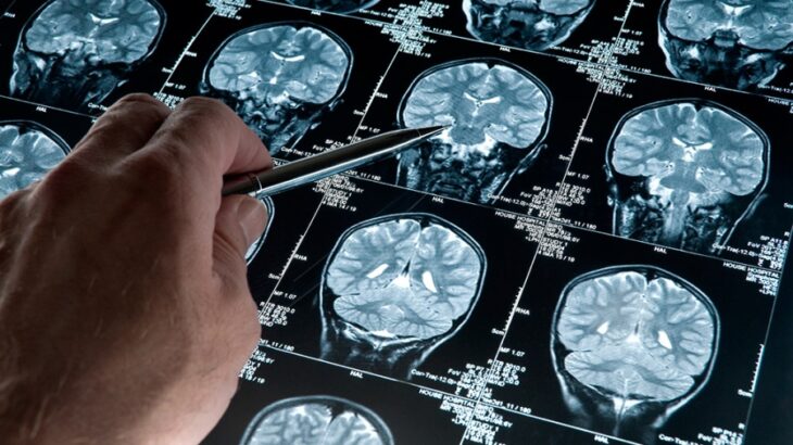 mano de un científico que señala las partes de un cerebro en unas radiografías