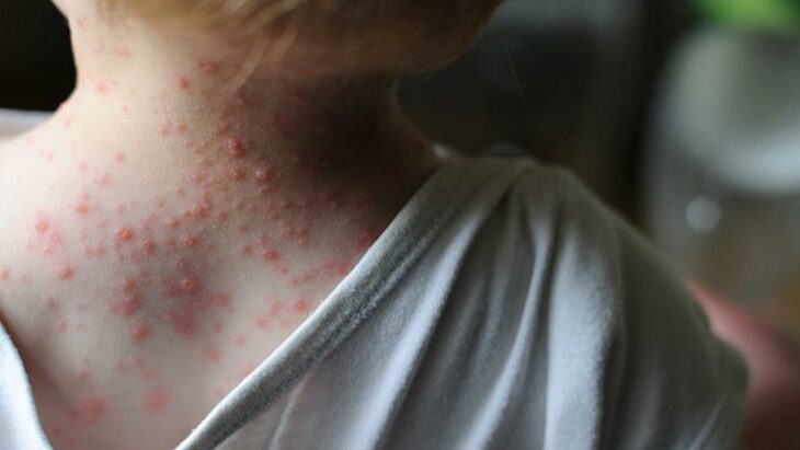 Spain issues health alert after 23 possible cases of monkeypox