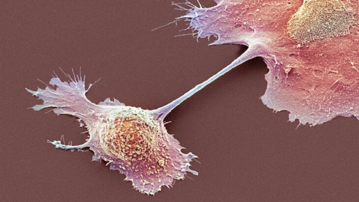 Reprogrammed cells attack and control a woman's deadly cancer