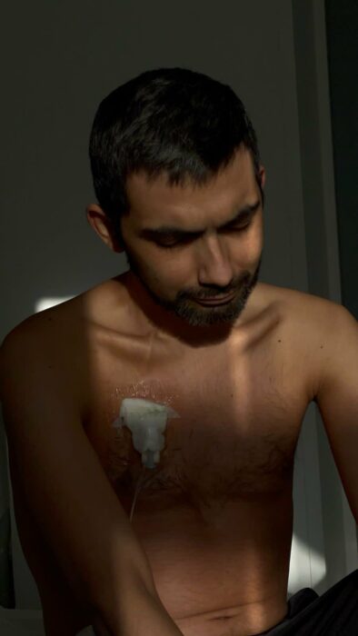 man with a catheter in his chest sitting on a hospital bed