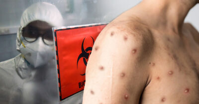 Brasil confirma la primera muerte a causa de la Viruela del Mono
