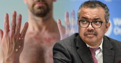 OMS declara oficialmente emergencia de salud pública mundial por la viruela del mono