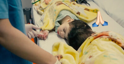 Gemelos brasileños unidos por el cráneo son separados con éxito