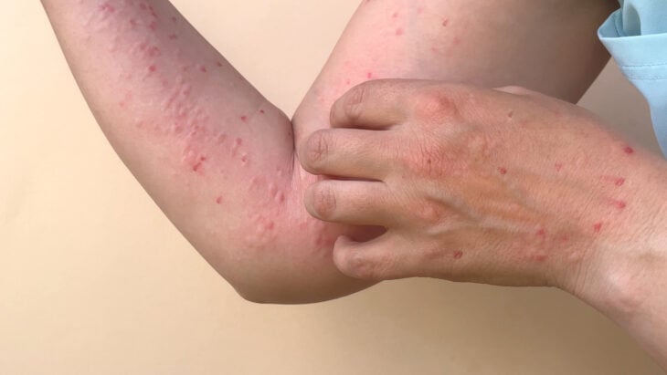 person with red blisters on arms and hands 