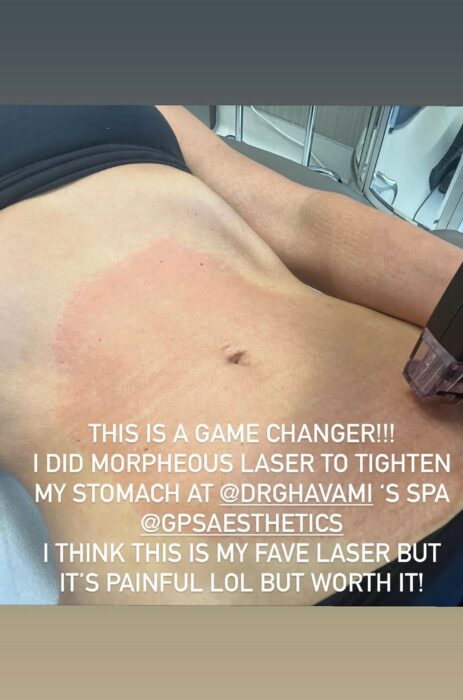 Kim Kardashian Morpheus treatment on abdomen