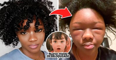 “Quedé como un emoji”: Chica terminó así tras una grave reacción alérgica al tinte