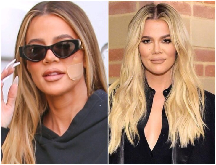 A Khloe Kardashian le quitaron un quiste de la cara