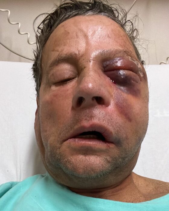 Foto de la cara de Alfredo Adame tras su intervención quirúrgica en su ojo derecho 