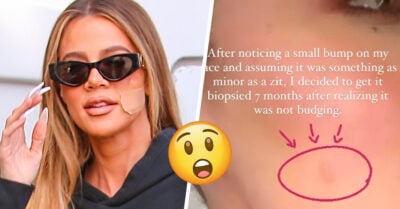 Khloé Kardashian habla sobre su ‘curita’ en el rostro y revela que le extirparon un tumor
