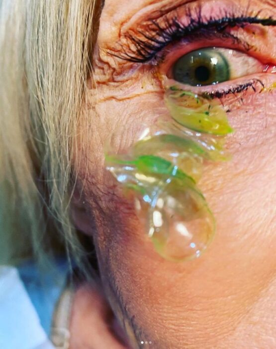 Doctora retira 23 lentes de contacto del ojo de una mujer que los olvidó ahí por un mes