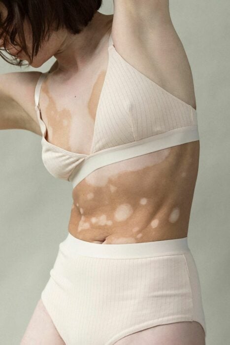Fotografía del cuerpo de una mujer con marcas de vitiligio en su cuerpo 
