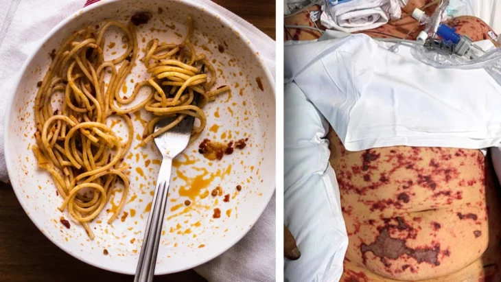 A man had his legs and fingers amputated after eating leftover noodles and suffered organ failureA man had his legs and fingers amputated after eating leftover noodles and suffered organ failureA man had his legs and fingers amputated after eating eat leftover noodles and suffer organ failure