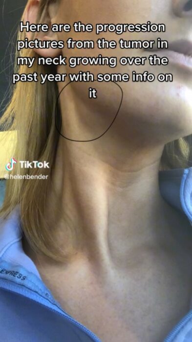 video screenshot of a girl who found out she had cancer thanks to a viral challenge on TikTok 