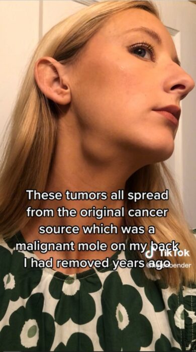 image of a girl who showed the cancer she detected by doing a viral beauty challenge on TikTok