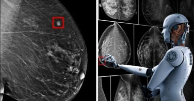 Cáncer de mama podría detectarse 5 años antes de aparecer con la Inteligencia Artificial