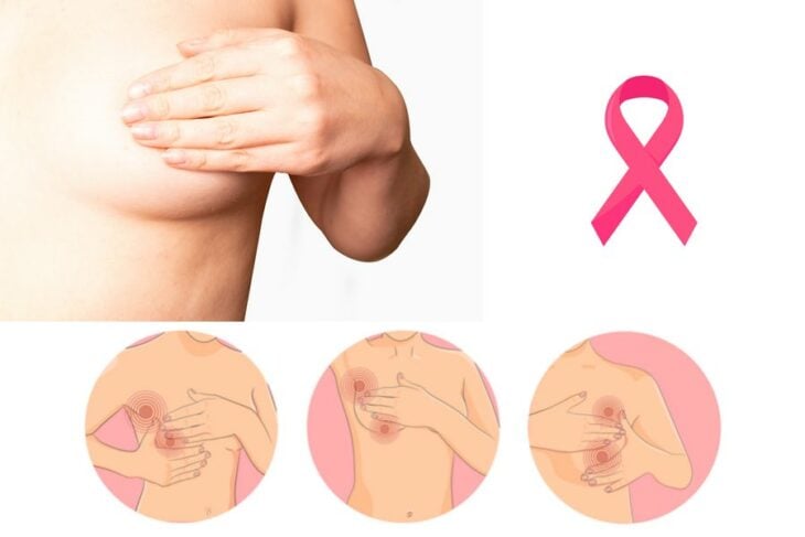 imagen ilustrativa de la autoexploración para el cáncer de mama 