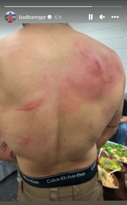 captura de pantalla de una historia en la que Bad Bunny muestra las marcas en su espalda tras pelea en WWE 