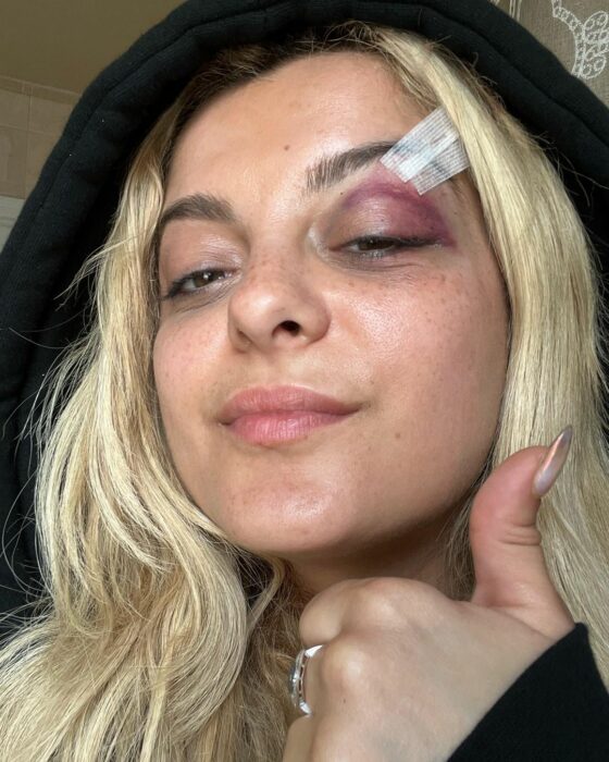 babe rexha con su ojo morado y ceja parchada